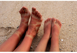 How to Treat Sunburns on Your Skin