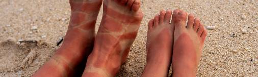 Wie man Sonnenbrände auf der Haut behandelt