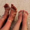 Wie man Sonnenbrände auf der Haut behandelt